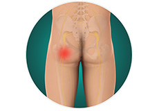 Buttock Pain