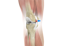 Medial Collateral Ligament Sprains