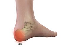 Heel Pain