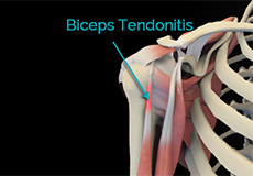 Tendon Injuries